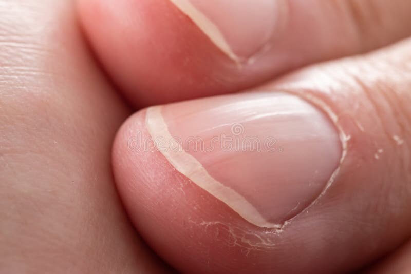 unhas com sulcos