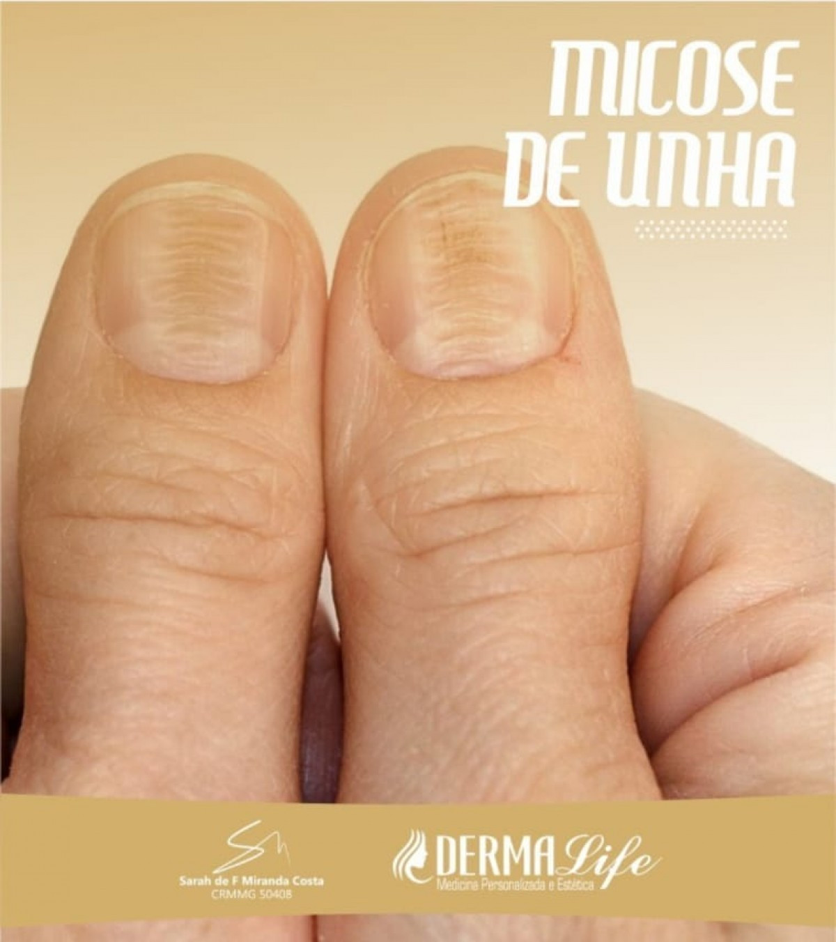 como curar micose na unha da mão