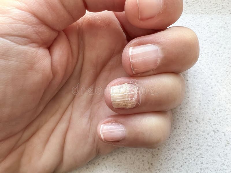 dermatologista micose unha