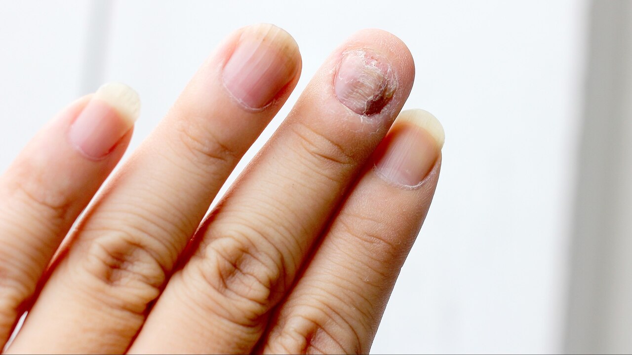 dermatologista micose unha
