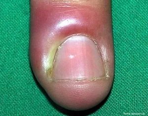 Como identificar os primeiros sinais de unha encravada na mão