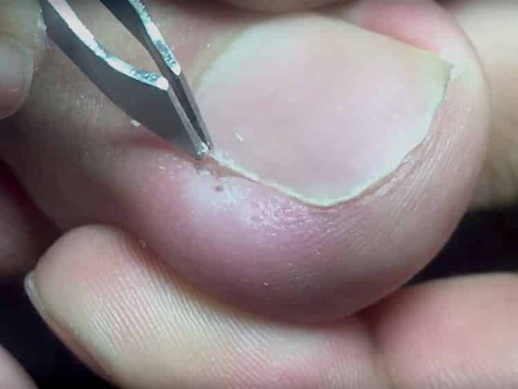 Guia completo de prevenção para unhas encravadas: Dicas de corte e cuidados