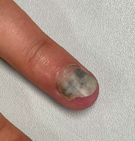 Como tratar unha inflamada em casa: Guia completo