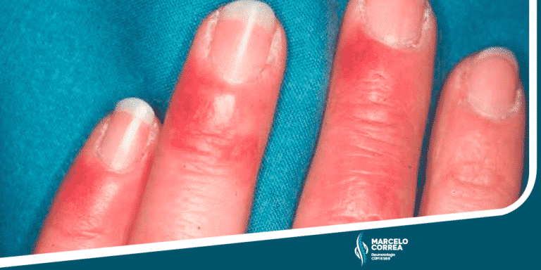 Unha encravada: Causas, sintomas e quando procurar um médico