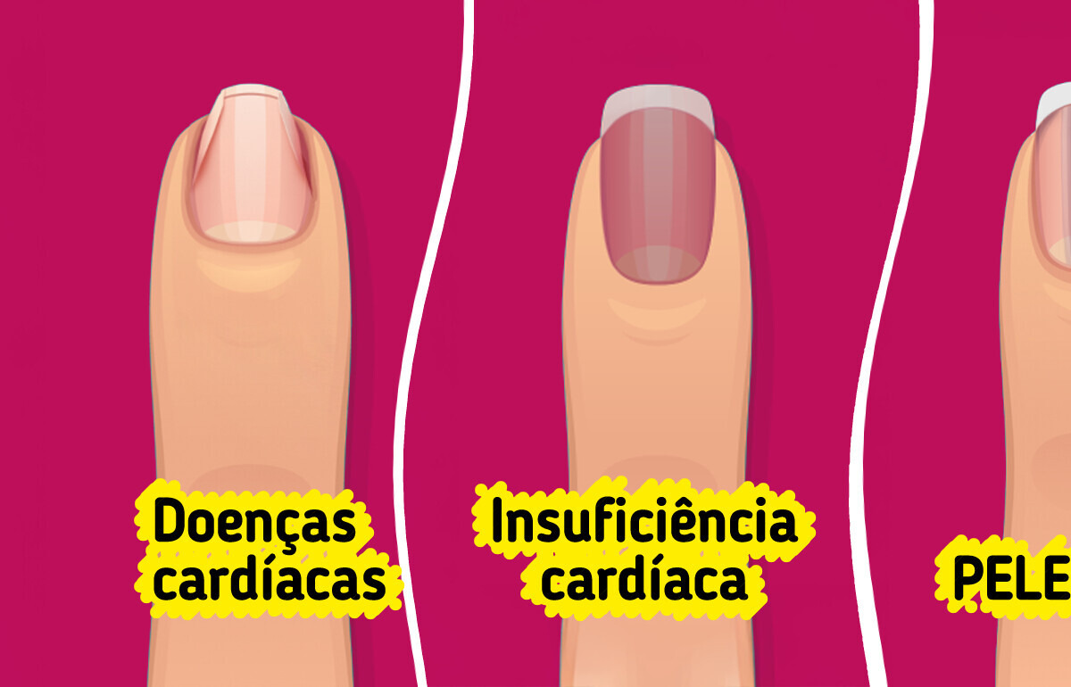 O que é paroníquia e como identificar os primeiros sinais