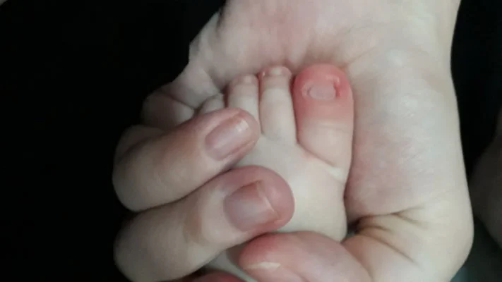 unha de bebe encravada