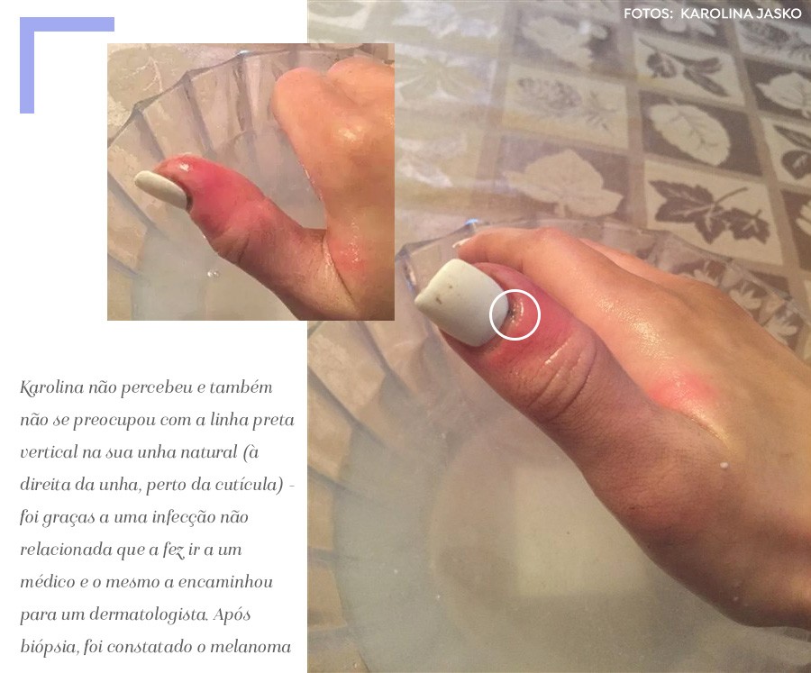 unha de gel faz mal para a saúde
