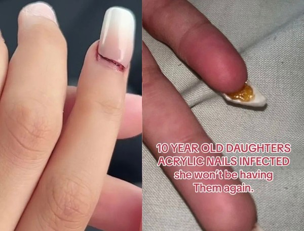 unha de gel pode causar câncer