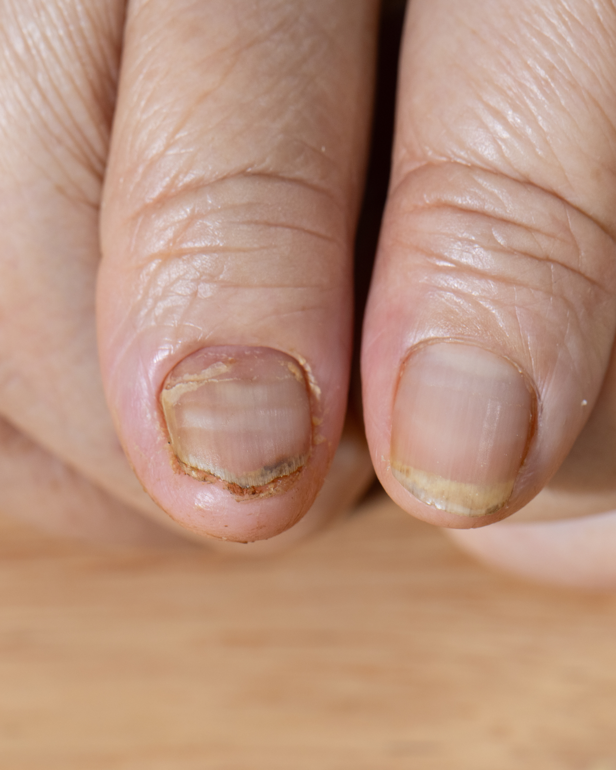unha descascando e com anemia