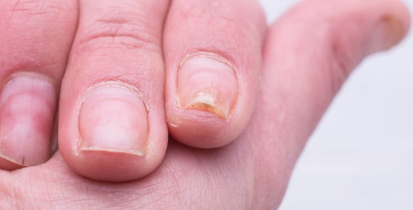 unha descascando após esmalte
