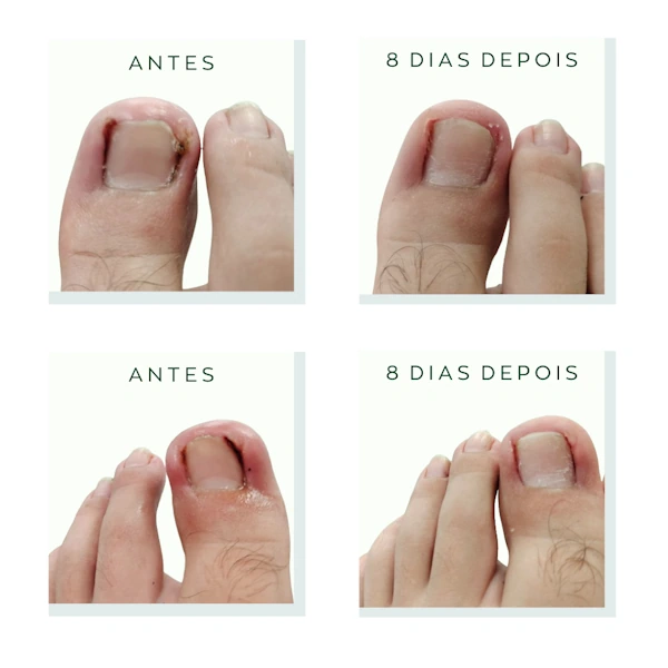 melhores dicas para evitar unha encravada