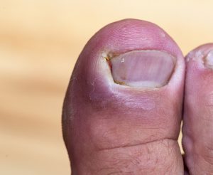 o que fazer quando a unha do pé encrava e inflama