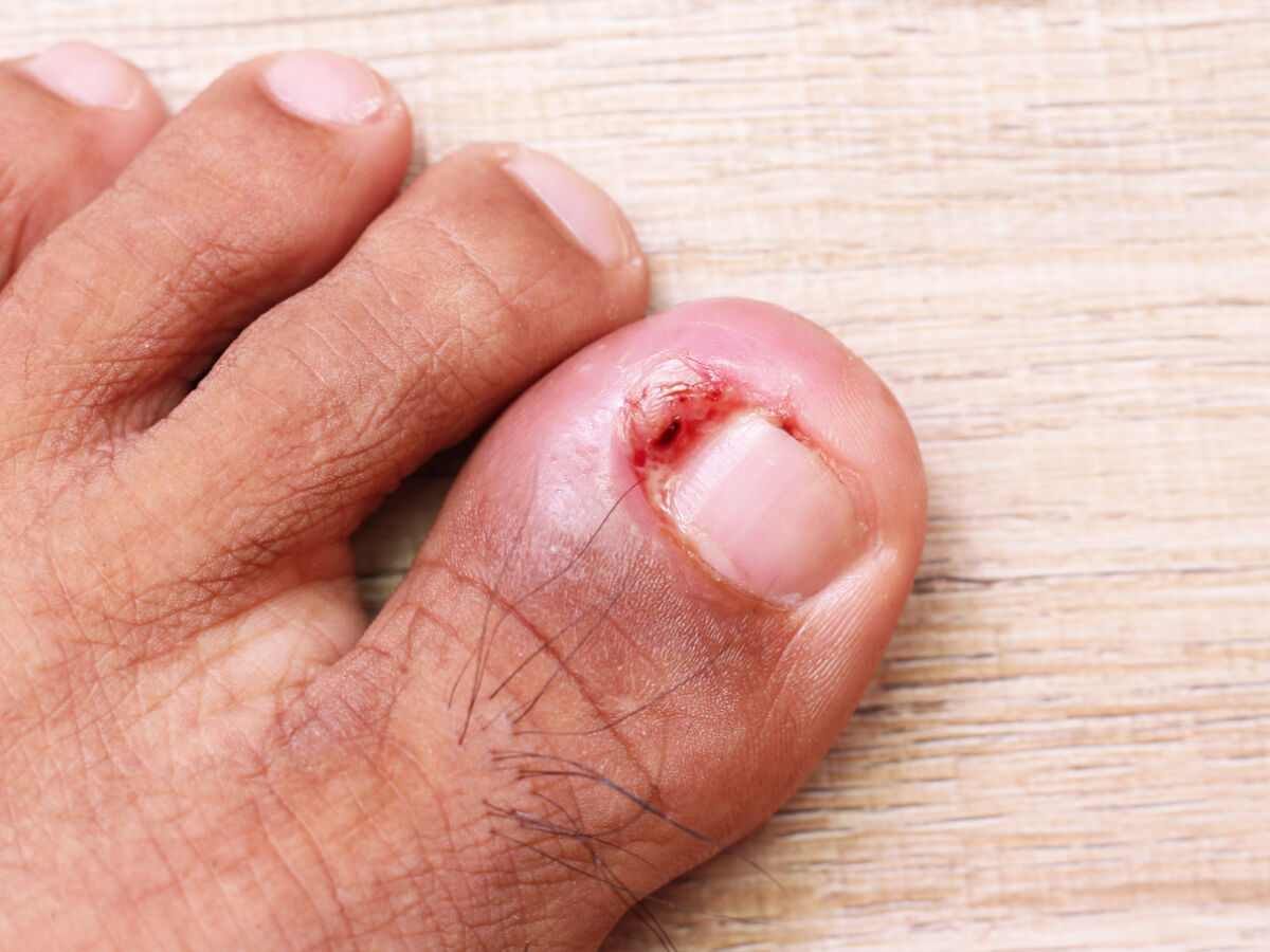 Como cortar unhas para evitar que encravem