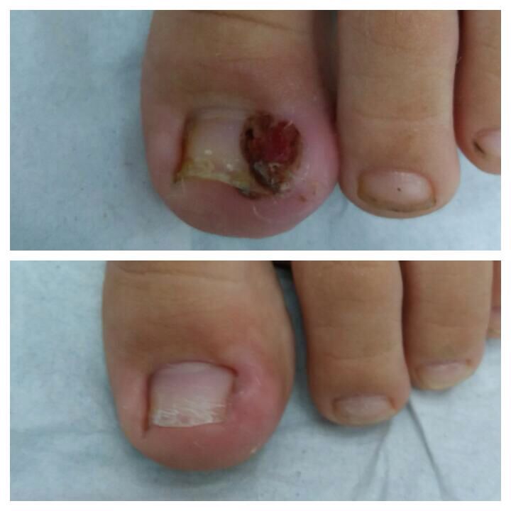 Diferença entre unha inflamada e unha encravada