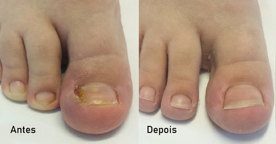 Remédios caseiros para aliviar dor de unha inflamada
