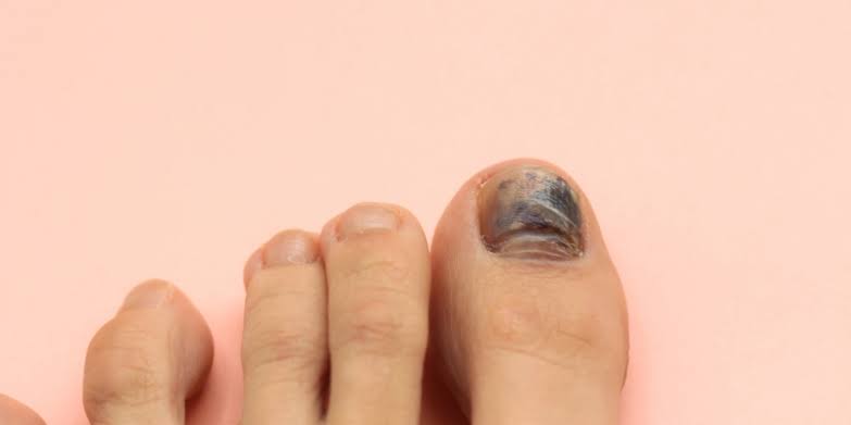 tratamento e como evitar a recorrência