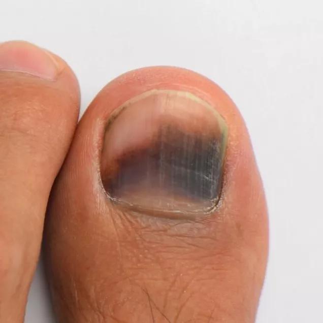 Melanoma ungueal: quando se preocupar com uma mancha escura na unha