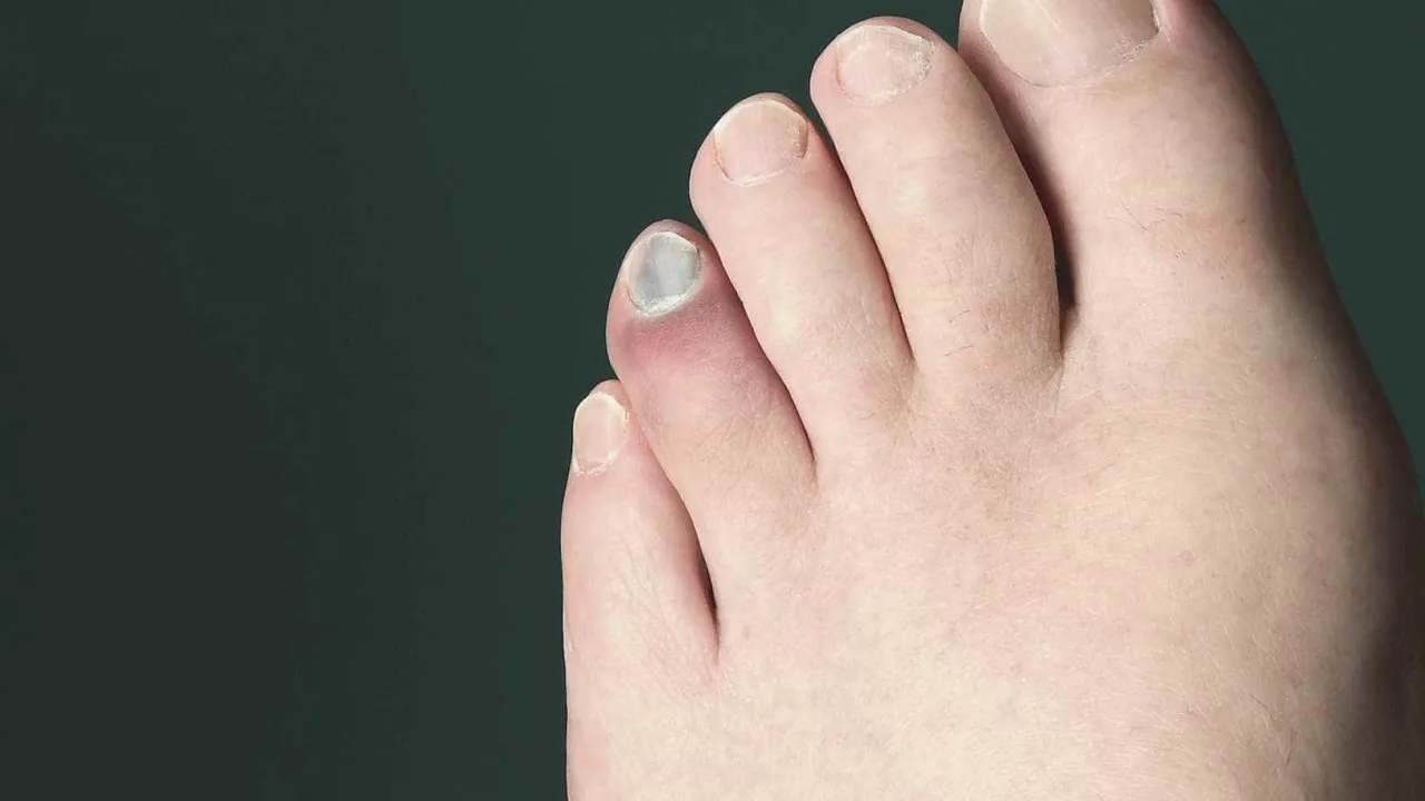 Como prevenir unhas pretas em atletas e corredores