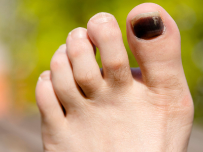 unha do pé preta com dor intensa o que fazer