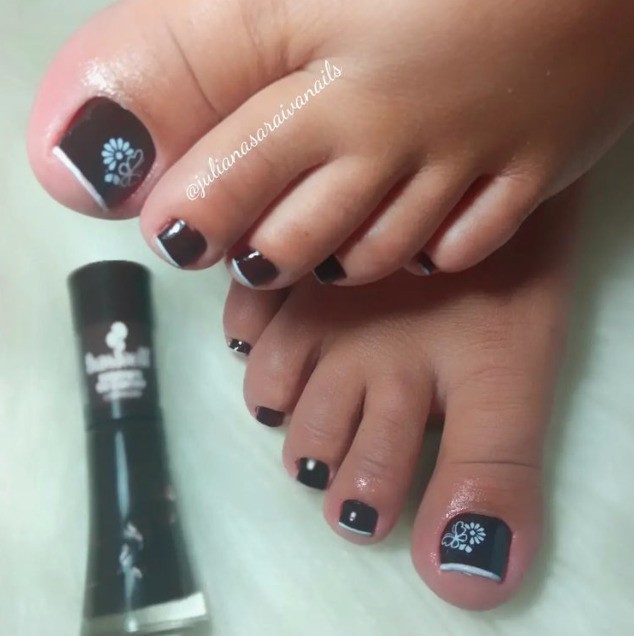 Hematoma subungueal: o que fazer quando a unha do pé fica preta após uma pancada?