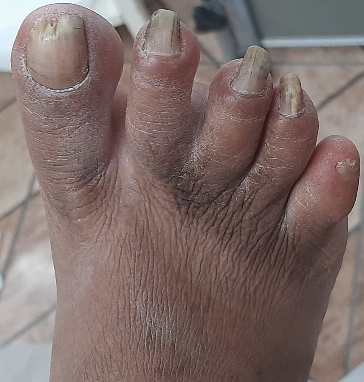 hipercurvatura da unha