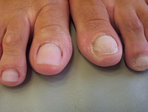 hipercurvatura da unha