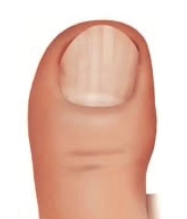 tratamento para unha encravada