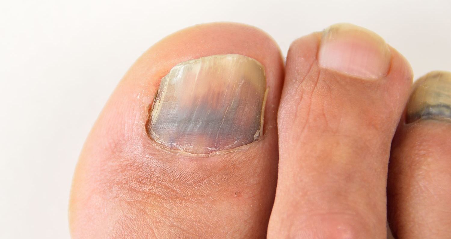 erros comuns ao tratar unha do pé roxa