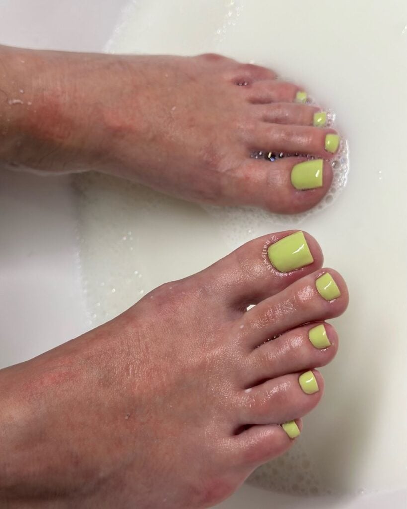 erros comuns ao tratar unha do pé verde