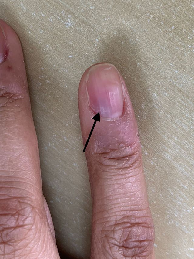 unha doendo por dentro