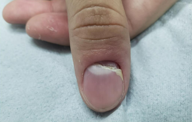 unha doendo por dentro