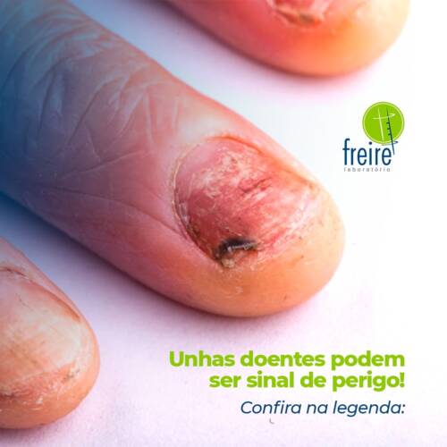 A relação entre unhas e doenças sistêmicas: um guia completo