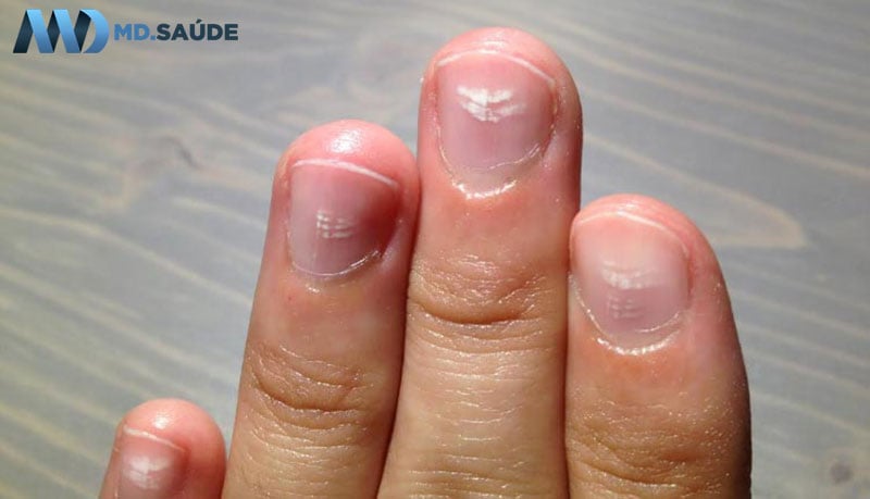 Unhas fracas e quebradiças: causas e como tratar