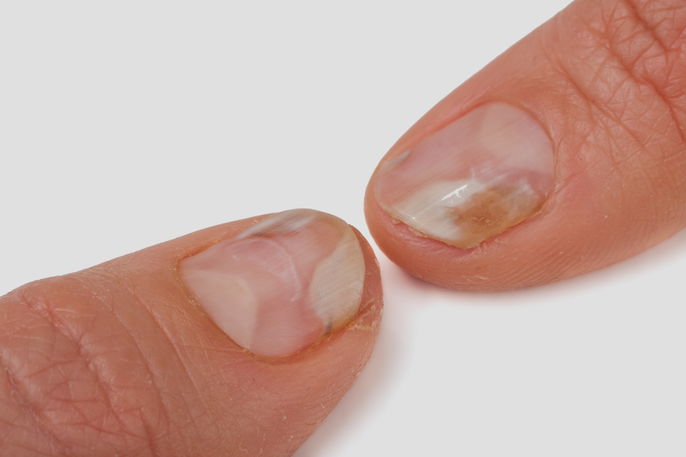 Cuidados essenciais para a saúde das unhas: prevenção e higiene