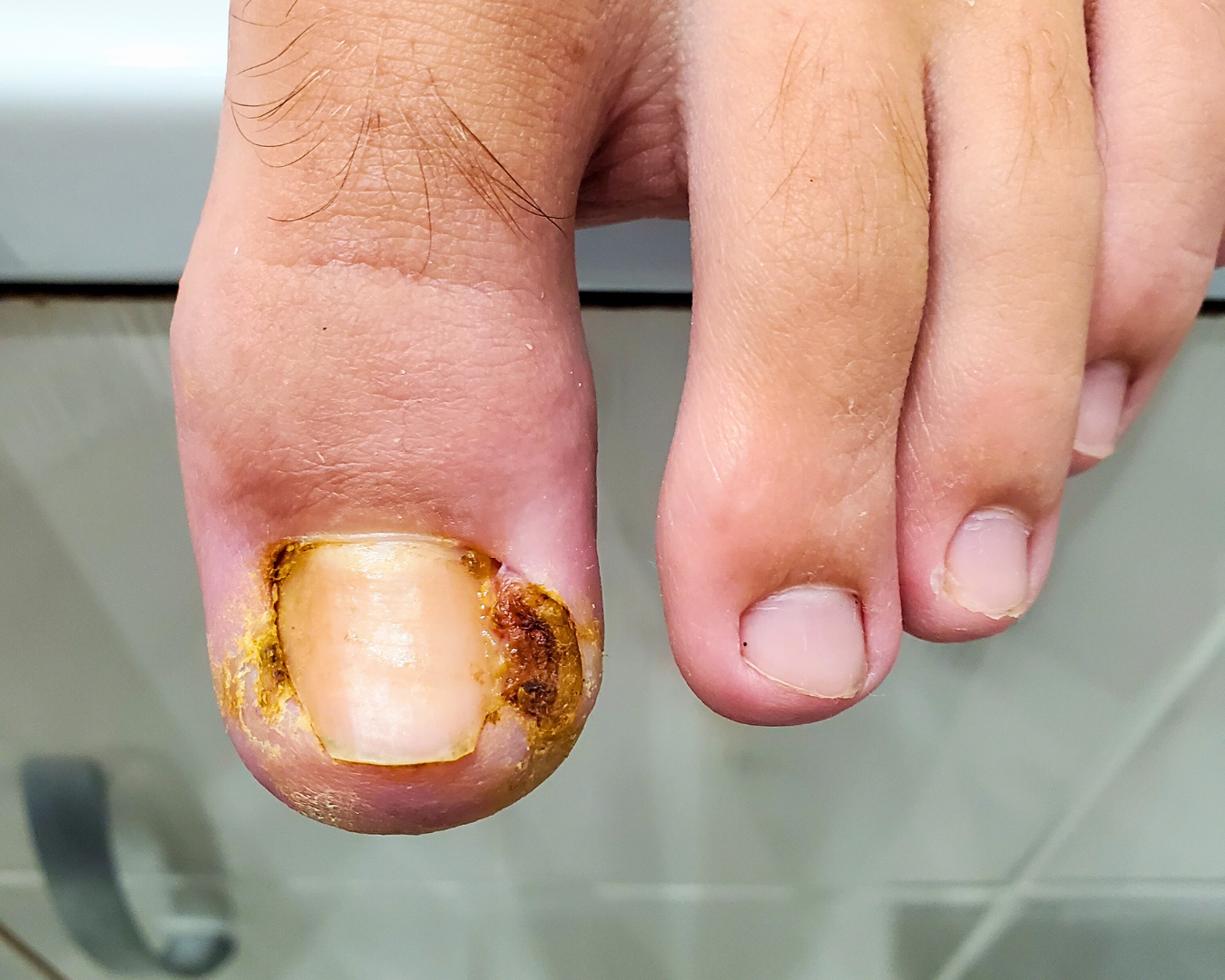 Guia Completo: Como Prevenir Unha Encravada de Forma Eficaz