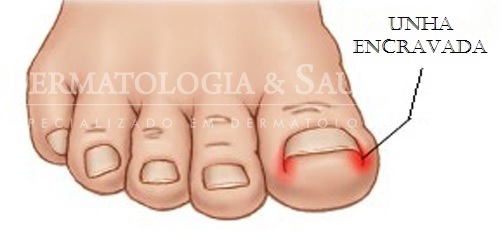 Diferença entre Podólogo e Dermatologista para Tratar Unha Encravada