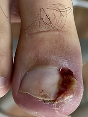 Guia Completo: Como Prevenir Unha Encravada de Forma Eficaz