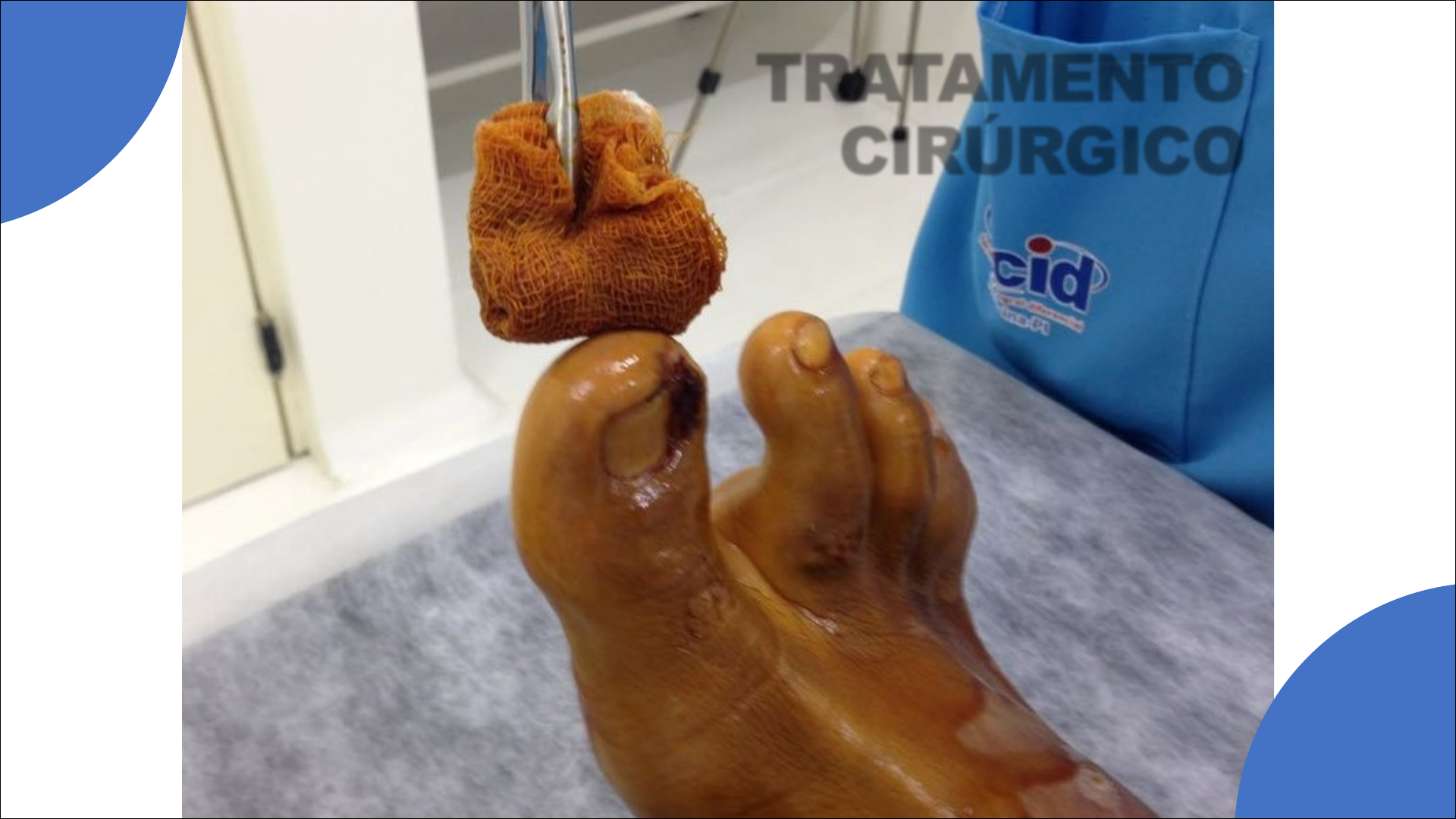 CID-10 L60.0: Entenda a Classificação da Unha Encravada; Onicocriptose: Causas