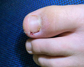 Sintomas e o Código L60.0 no CID-10; Guia Completo sobre o CID-10 L60 (Afecções das Unhas); Tratamento da Unha Encravada: O Que o CID-10 L60.0 Implica?; Diferenças entre L60 e L60.0 no CID-10 para Unhas