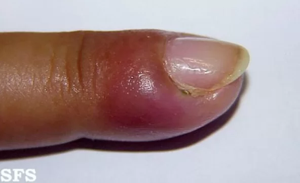 Unha encravada e diabetes: Riscos e cuidados especiais