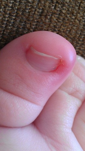 bebe chorando com unha encravada o que fazer