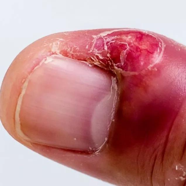 5 ideias de títulos:
1. Unha Encravada: Guia Completo de Alívio e Prevenção
2. Os Perigos da Unha Encravada e Quando Procurar um Médico
3. Tratamentos Eficazes para Unha Encravada: Do Caseiro ao Cirúrgico
4. Como Evitar que a Unha Encrave Novamente: Dicas Essenciais
5. Entenda a Cantoplastia: A Solução Cirúrgica para Unhas Encravadas