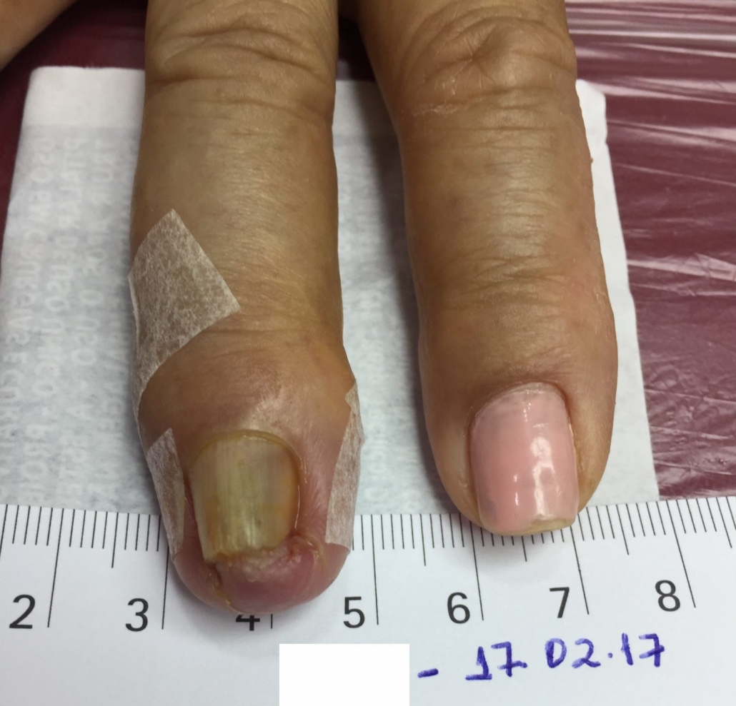 Unha Encravada na Mão vs. Pé: Entenda as Diferenças e Cuidados