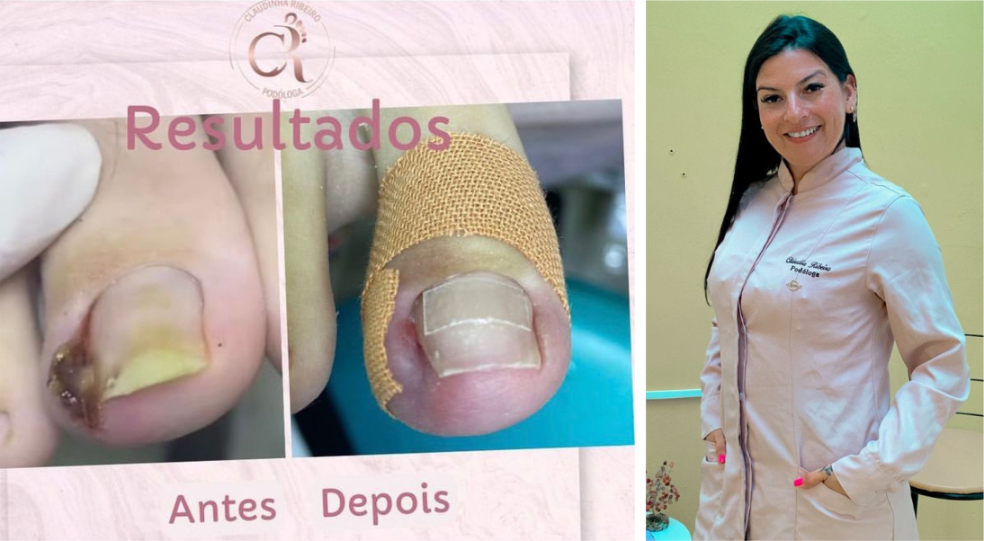 unha encravada pode matar