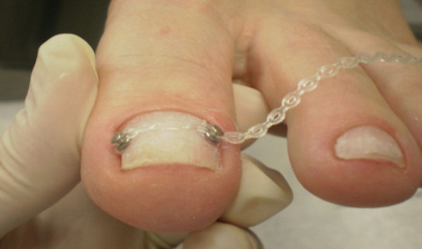 unha encravada pode matar