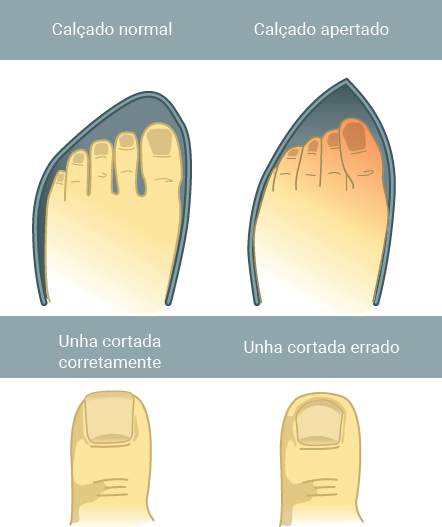 Onicofose vs. Unha Encravada: Entenda as Diferenças
