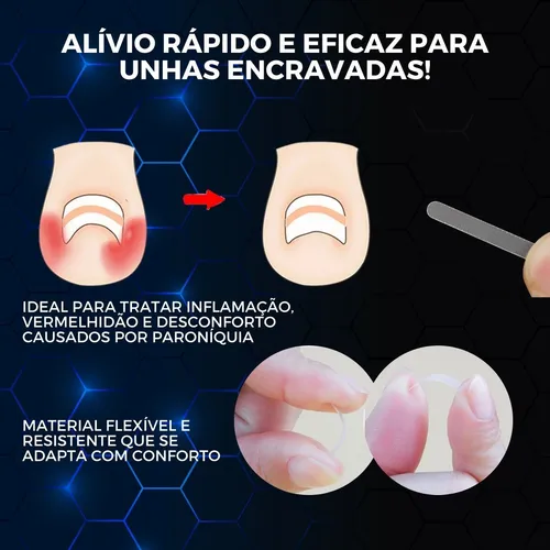 Onicofose vs. Unha Encravada: Entenda as Diferenças