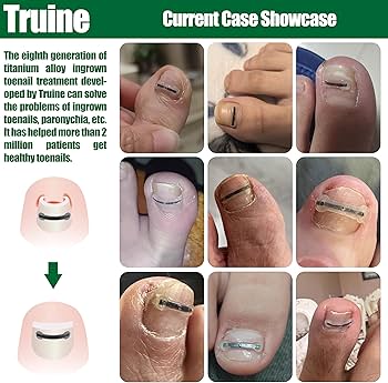 Granuloma Piogênico: O Que Fazer Quando a Unha Encravada Piora?