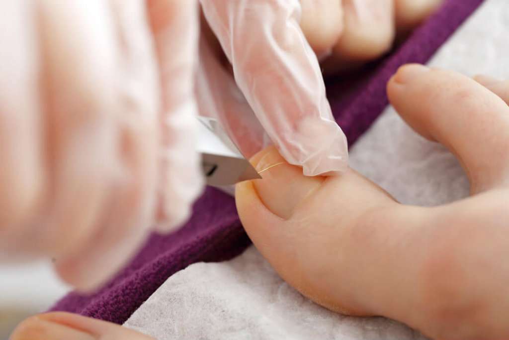 Cantoplastia: O Procedimento Cirúrgico para Unhas Encravadas