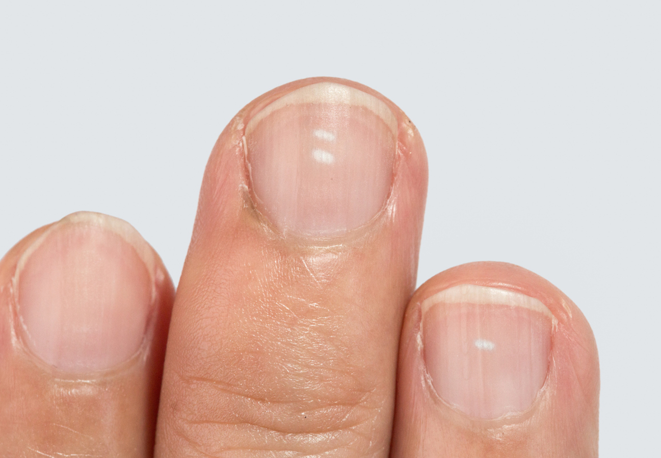 Leuconíquia: Entenda as Causas e Tratamentos para Manchas Brancas nas Unhas; Micose ou Trauma? Desvendando as Manchas Brancas nas Unhas; Guia Completo: Como Prevenir e Tratar Unhas Esbranquiçadas; Quando Procurar um Médico para Manchas Brancas nas Unhas: Sinais de Alerta; A Relação entre Esmaltes